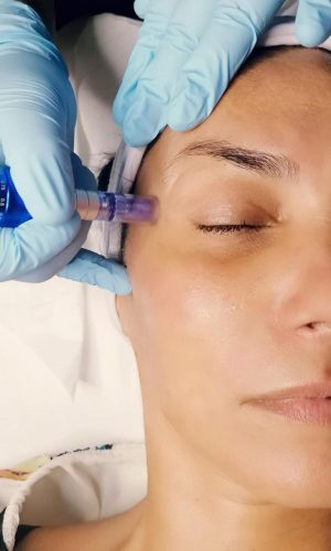 micropigmentazione sopracciglia lamanna derma specialist 3